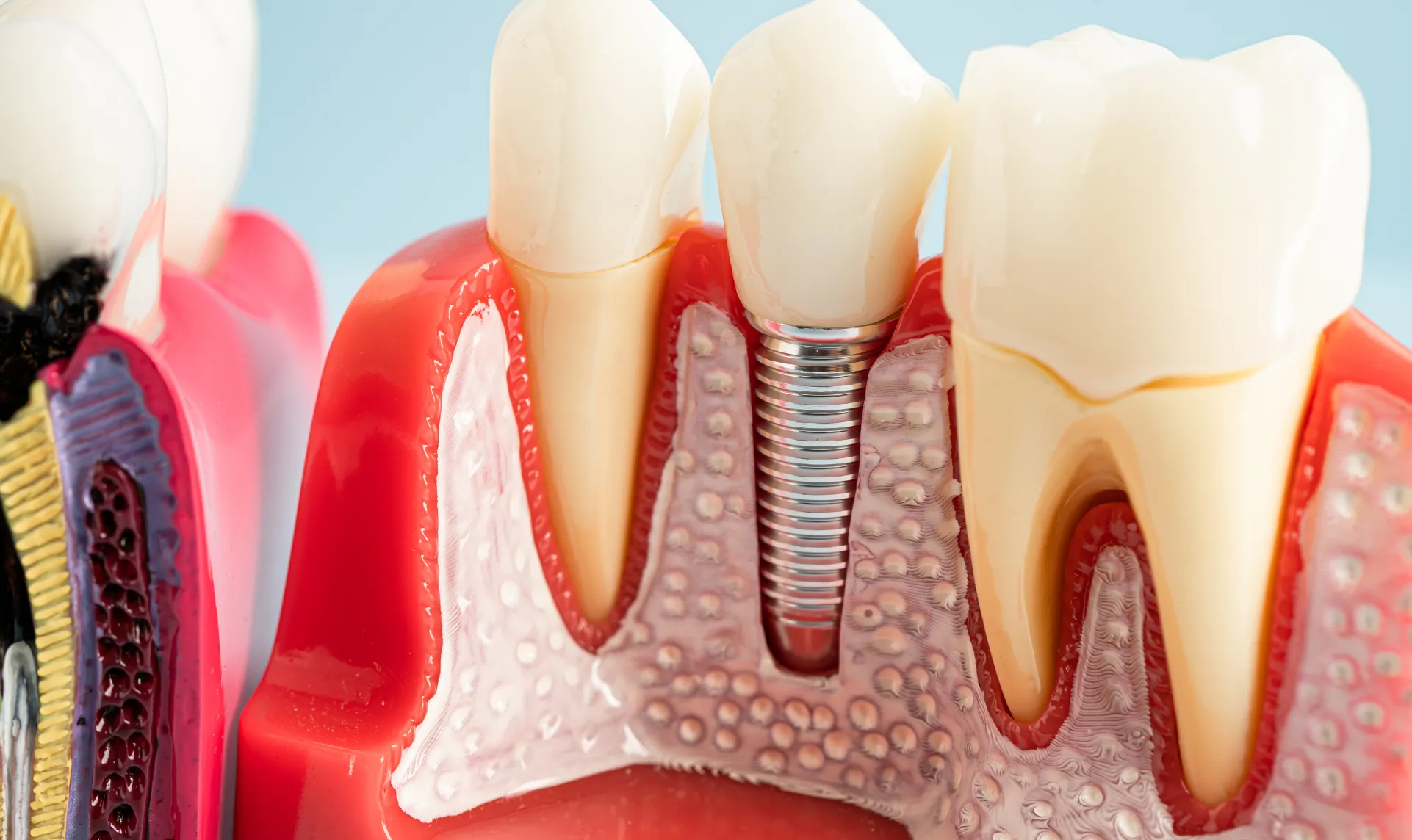 Implantes